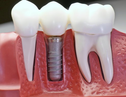 Implantatsiya
